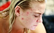 Come prevenire e curare le imperfezioni della pelle causate da brufoli anche da adulti