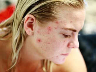 Come prevenire e curare le imperfezioni della pelle causate da brufoli anche da adulti